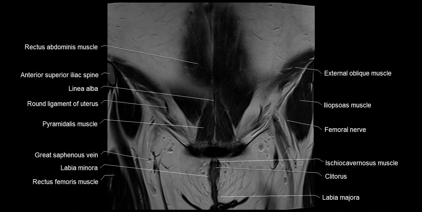 female pelvis coronal cross sectional anatomy image 5.webp